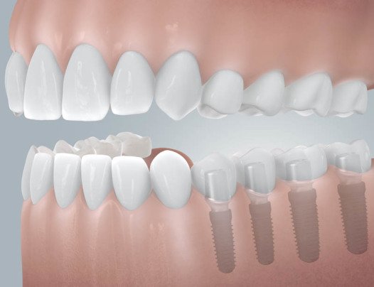 verkürzte Zahnreihe mit Implantaten.jpg