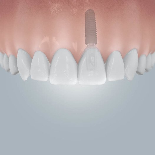 Zahnlücke + Implantat.jpg