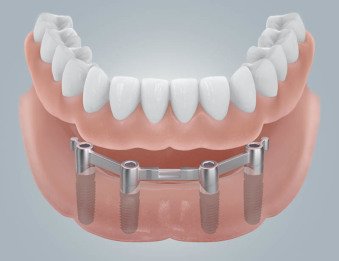 Schmuckfoto: Unterkiefer mit 4 Implantaten und einer Stegkonstruktion sowie Prothese