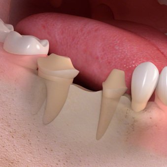 abgeschliffene Zähne / Zahnstümpfe für Brücke