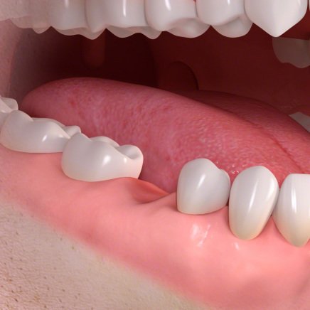 Zahnlücke - fehlender Zahn.jpg