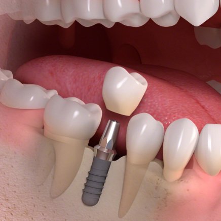 Implantat mit Zahnkrone als Zahnersatz