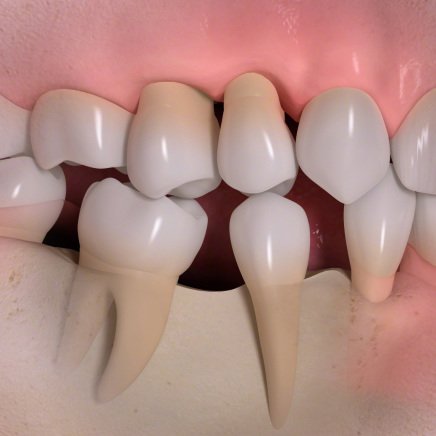 Zahnkippung + Entzündungen als Folge des Zahnverlustes