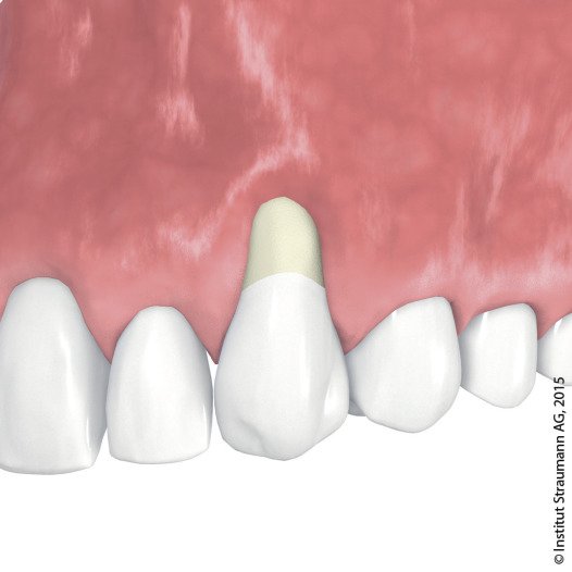 Rezession - Zahnfleischrückgang.jpg