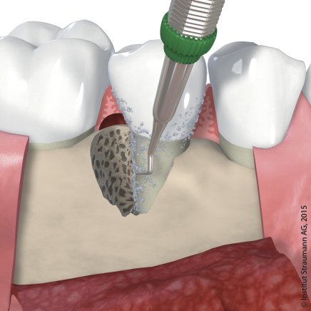 Entfernung der Bakterien - Parodontalchirurgie.jpg