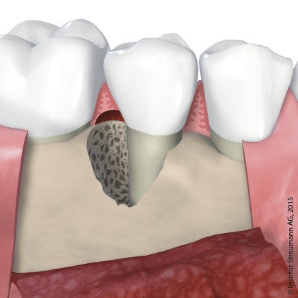 tiefe Knochendefekte am Zahn durch Bakterien.jpg