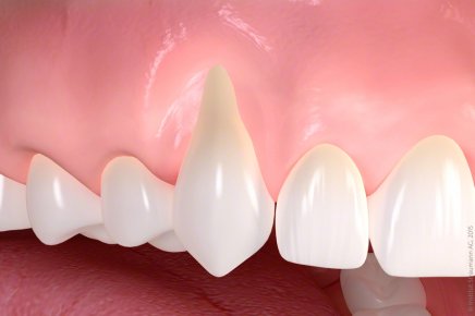 Behandlung von Zahnfleischschwund_01.jpg