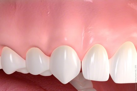 Behandlung von Zahnfleischschwund_05.jpg